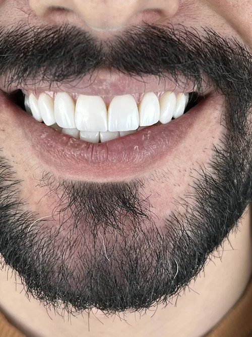 کامپوزیت دندان