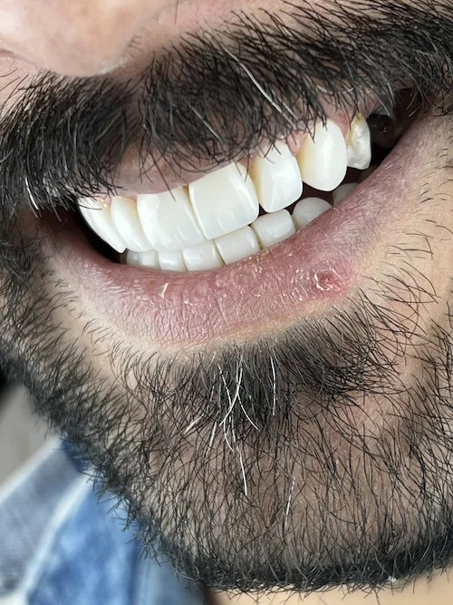کامپوزیت دندان